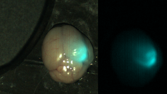 Figure 2: Near-infrared imaging of brain tumors using the Tumor Paint BLZ-100, On the left, a white light image is overlaid with an NIR image; on the right, a separate NIR image is shown 